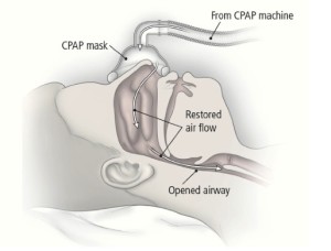 CPAP_machine_image